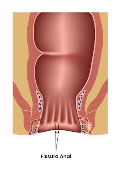 Fissura Anal Grupo Elas Cl Nica Da Mulher